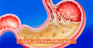 أسباب-حرقة-المعدة
