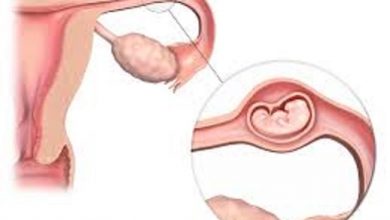 أعراض الحمل خارج الرحم وطرق تشخيصه والعلاج المناسب أعراض-الحمل-خارج-الرحم