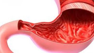 أعراض-القولون-التقرحي