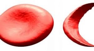 أعراض فقر الدم للأطفال والنساء أعراض-فقر-الدم