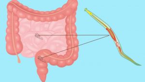 اعراض الديدان الدبوسية عن الكبار
