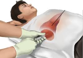 تضخم الكبد الأسباب والأعراض وعلاجة النهائي تضخم-الكبد