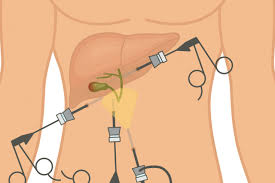 حصوات-المرارة