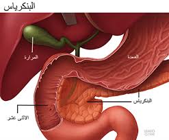 حصوات-المرارة