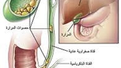 حصوات المرارة وعلاجها بالمنظار حصوات-المرارة