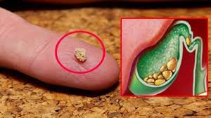 حصوات-المرارة