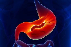 علاج جرثومة المعدة