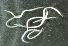 علاج ديدان المهبل عند النساء