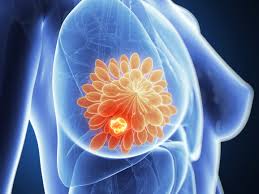 ماهي أعراض سرطان الثدي؟ ما هي أعراض سرطان الثدي