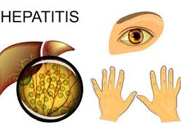 مرض-الكبد-الوبائي