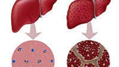 مرض الكبد الوبائي 5 أنواع مرض-الكبد-الوبائي