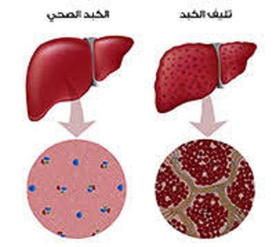 مرض-الكبد-الوبائي