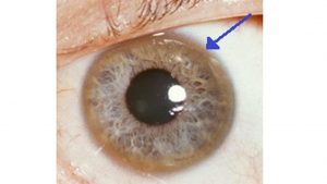 هل مرض ويلسون مميت