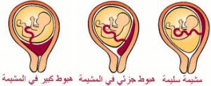 أسباب-نزول-المشيمة