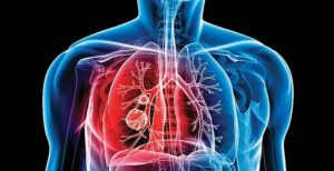 أعراض السل أعراض-السل