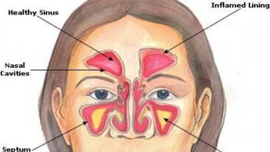أعراض حساسية الأنف أعراض-حساسية-الأنف