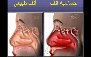 أعراض حساسية الأنف أعراض-حساسية-الأنف