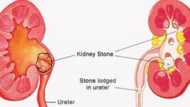 أعراض-حصوة-الحالب