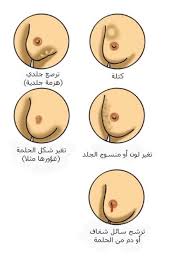 أعراض-سرطان-الثدى