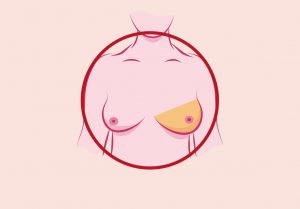 أعراض-سرطان-الثدى