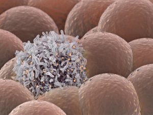 أعراض سرطان الدم و الأسباب أعراض-سرطان-الدم