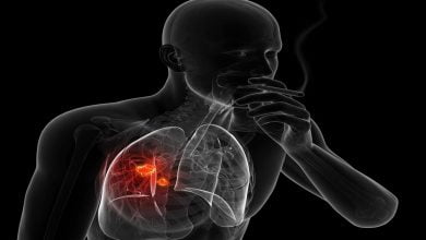 أعراض سرطان الرئة أعراض-سرطان-الرئة