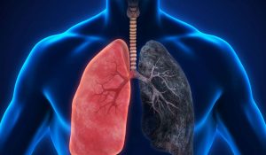 أعراض-سرطان-الرئة
