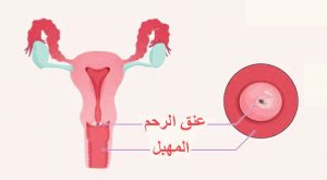 أعراض-سرطان-الرحم