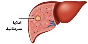 أعراض سرطان الكبد وطرق الوقاية منه أعراض-سرطان-الكبد