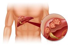 أعراض سرطان الكبد وطرق الوقاية منه أعراض-سرطان-الكبد