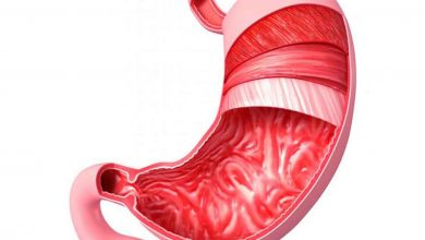 أعراض-سرطان-المعدة