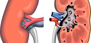 أعراض_الفشل_الكلوي