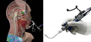 التهاب الجيوب الأنفية في الشتاء التهاب-الجيوب-الأنفية