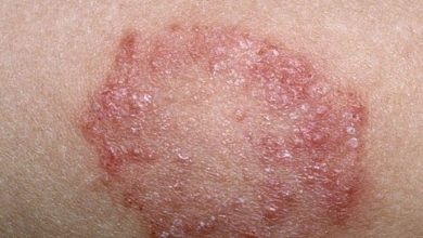 علاج-الارتكاريا