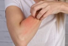 علاج حساسية الجلد علاج-حساسية-الجلد