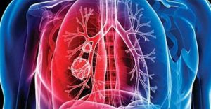 ما هو الدرن ما هو الدرن