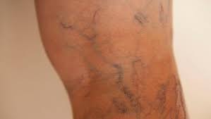 ما-هو-علاج-تليف -الكبد