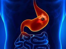 أعراض-مرض-جرثومة-المعدة-والعلاج