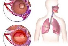 مرض الالتهاب الرئوي وعلاجه مرض الالتهاب الرئوي