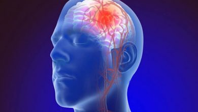 مرض تصلب شرايين المخ وعلاجه تصلب شرايين المخ