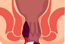 علاج البواسير في المنزل