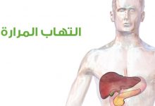 التهاب المرارة الحاد التهاب المرارة الحاد