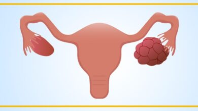 تكميم المعدة وتكيس المبايض تكميم المعدة وتكيس المبايض