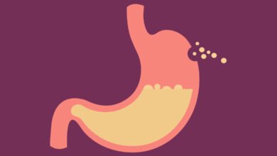 هل تكميم المعدة خطر طرق تدبيس المعدة طبيعياً