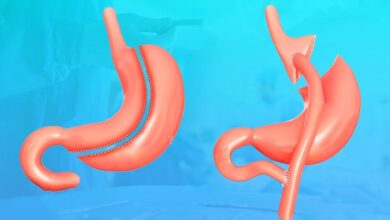 تكميم المعدة وتحويل المسار