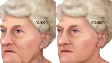 عمليات تجميل شد الوجه عمليات تجميل شد الوجه