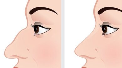 اضرار عمليات التجميل للانف ما يمكن ان تعالجه عملية تجميل الانف