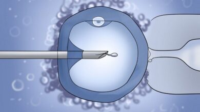 التخسيس قبل الحقن المجهري التخسيس قبل الحقن المجهري