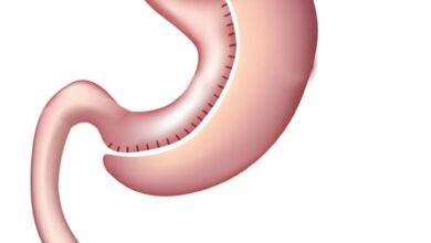 تدبيس المعدة سعر