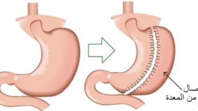 مخاطر عملية تدبيس المعدة